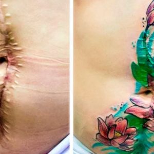21 Tattoos Turn Scars That People Don’t Want to Hide Anymore Into Art