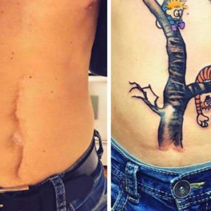 Inspirational Tattoos That Turn Scars Into Beautiful Works Of Art