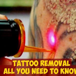 Tattoo Removal ► All You Need To Know